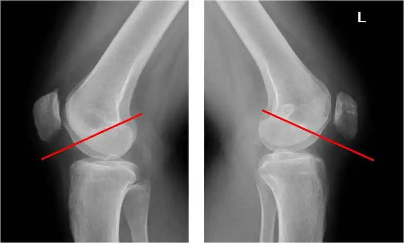 复发性髌骨脱位和习惯性髌骨脱位的手术治疗