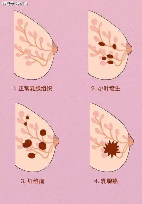 视,触,捏三步自测|乳腺纤维腺瘤|乳腺结节|乳腺增生|良性肿瘤|恶性