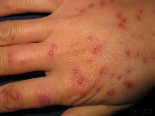 看图识病多形红斑