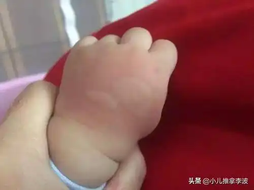 小儿推拿李波:小儿荨麻疹的病因病机,中西医治疗及小儿推拿案例