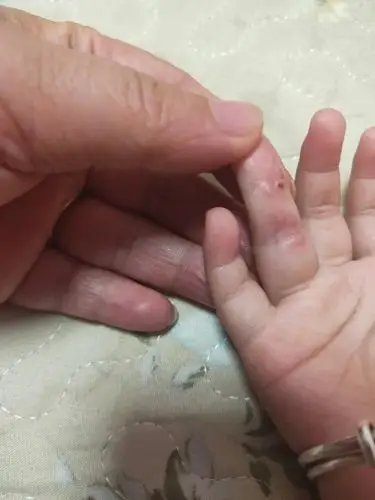 请问大家宝宝手指长出这种泡,是什么原因?什么病?怎么治疗?