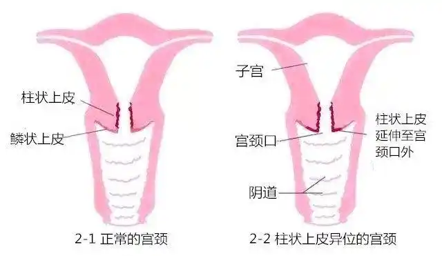 内的是鳞状上皮细胞,而靠近子宫那个方向的是柱状上皮细胞(如图1所示)