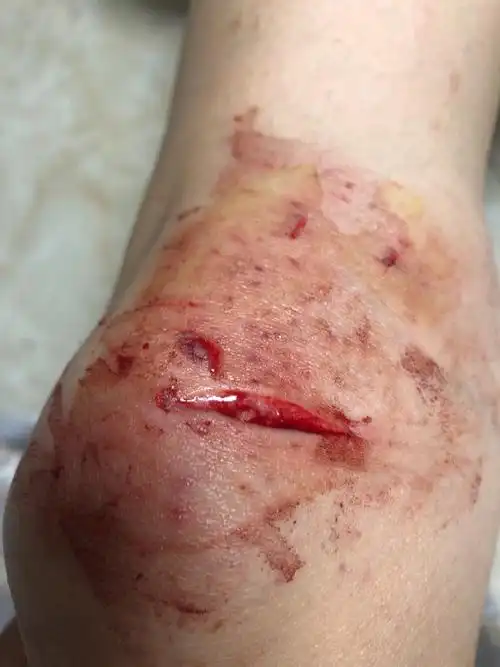 我骑车子摔了一膝盖划破了 用碘伏消毒了 麻烦帮忙看看需不需要去医院