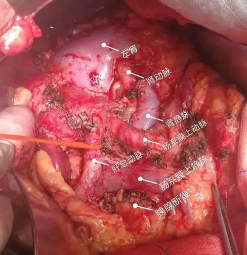 晚期胰腺癌的治疗奇迹 - 好大夫在线