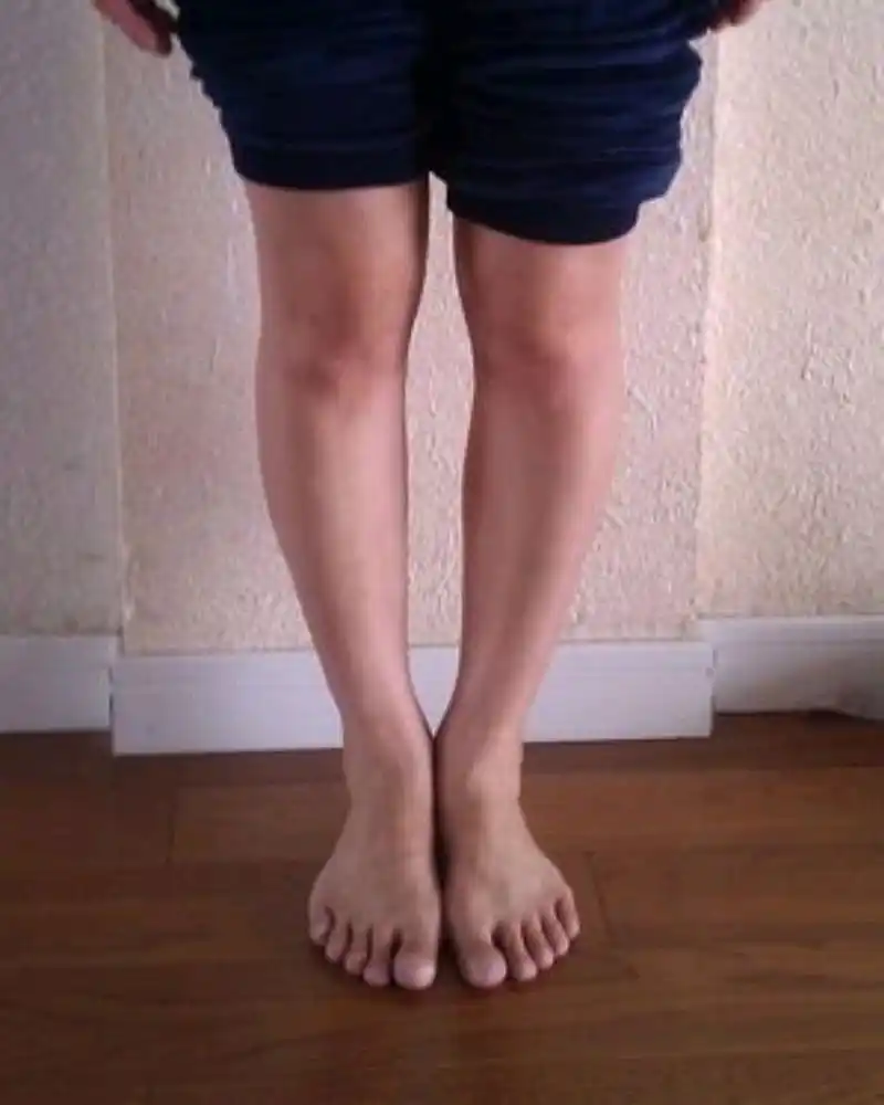 为什么我的腿型是歪的,那么难看?医生说,要考虑有没有拇外翻了