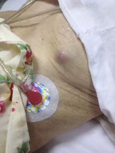 奶奶胸部长了一个突出肿块,这是什么