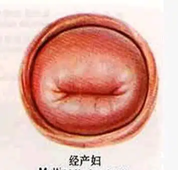 生育过的女性宫颈口呈"-"型未生育的女性宫颈口呈"o"型.