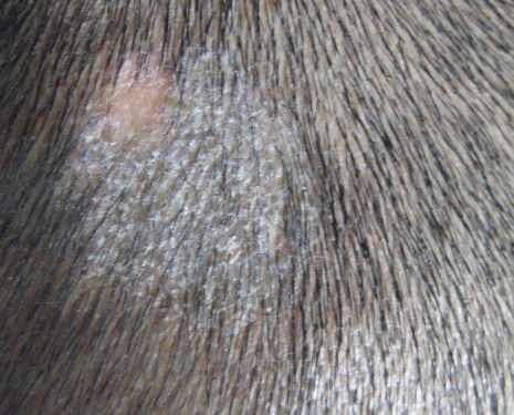 头癣的症状图片 (9)