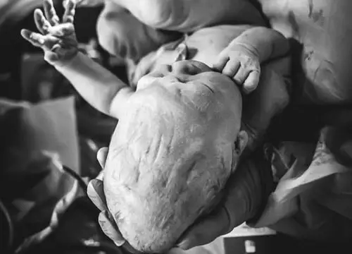 刚出生的宝宝头部被挤压严重变形,医生却说这很正常