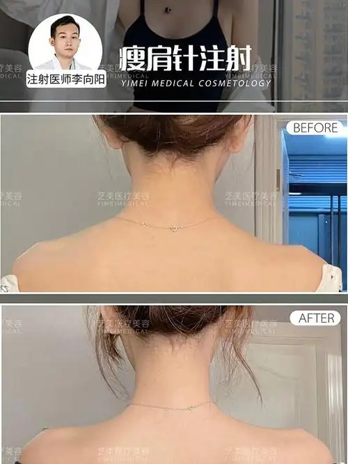 艺美丶瘦肩针注射对比