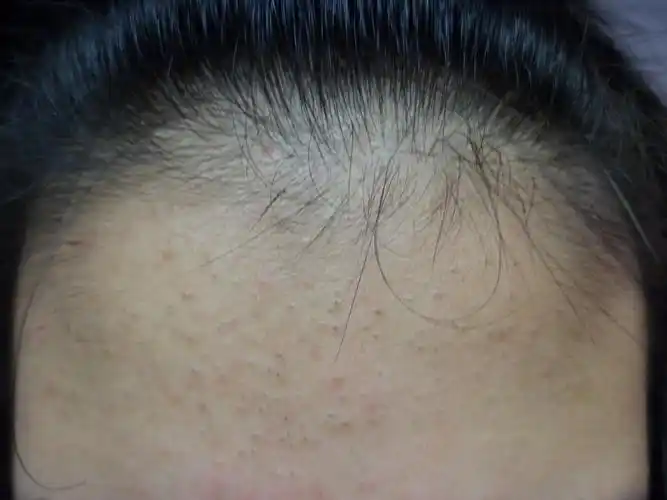 额头上长了这些小黑点,不知道是什么,怎么治呢?