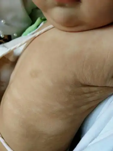 九个月宝宝,白色糠疹!急啊