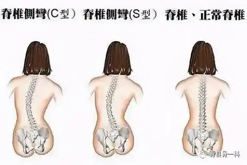 一直不采取治疗措施的话,可能会导致脊柱改变,患者在做生理弯曲,站立
