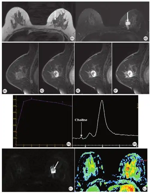 磁共振成像对形态学表现为良性特征的乳腺恶性肿瘤诊断价值