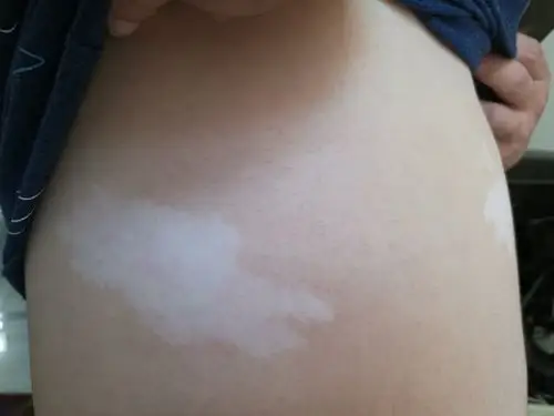 成人无色素痣典型病例一例! - 好大夫在线