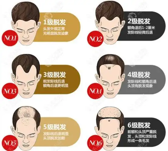 脱发一共有七级,对于m字脱发可以说是2,3级脱发