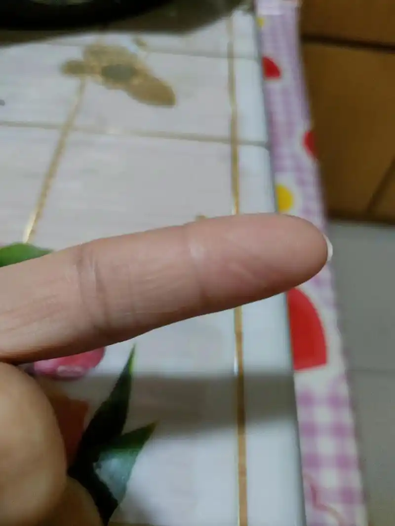 今天做饭不小心烫伤手指头了气泡010101有什么好办法,那位 - 抖