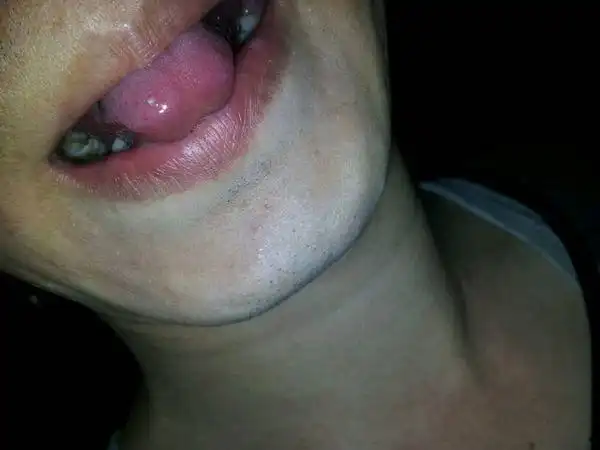 舌头上长了一个小米大的一个白点,有四五天