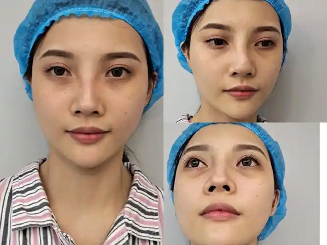 【术前诊断】:90患者鼻部多次注射玻尿酸,鼻梁山根位_圈子-新氧美容