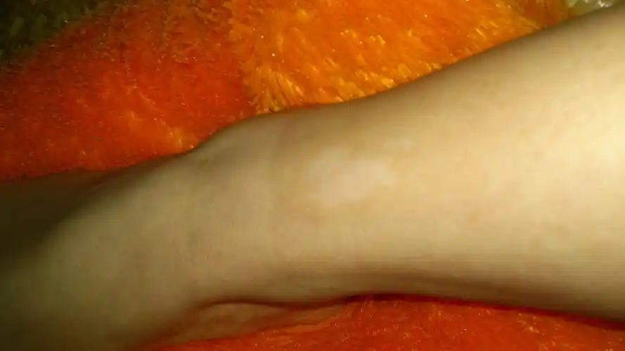 脚踝处长了一个白斑,已经有一两年了吧,没有注意,今天问医生说有可能