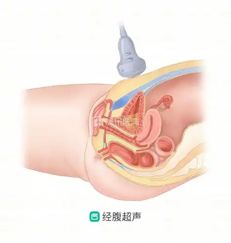 妇科超声检查竟然分为这4种,医生揭秘它们各自的优缺点,女性务必要