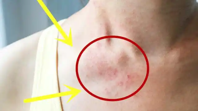 艾滋病初期表现不论男女脖子若有这标志要当心