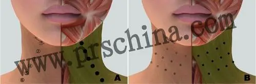 肉毒素注射案例——颈纹