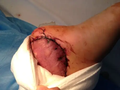 大面积皮瓣手术后植皮区皮肤变紫黑色并有水泡,这样子是否已经成活?