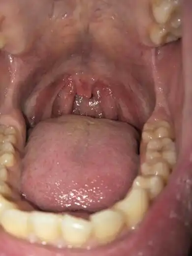 咽部粘膜受损,没有炎症,人匝,喝千木什能修复吗