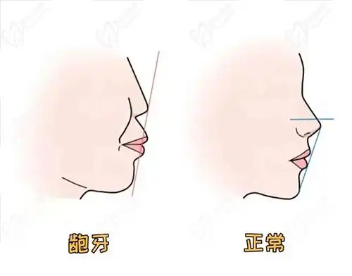 骨性龅牙如果做牙齿矫正一般可以内收几毫米呢?