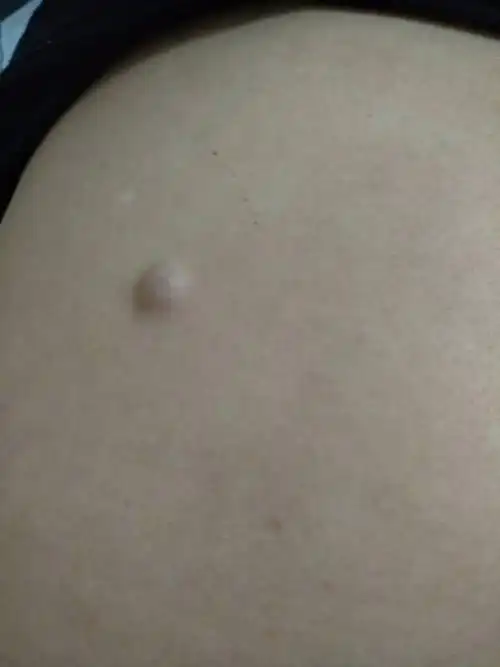 背后长了疙瘩,不疼不痒,也没有感觉,是什么呀