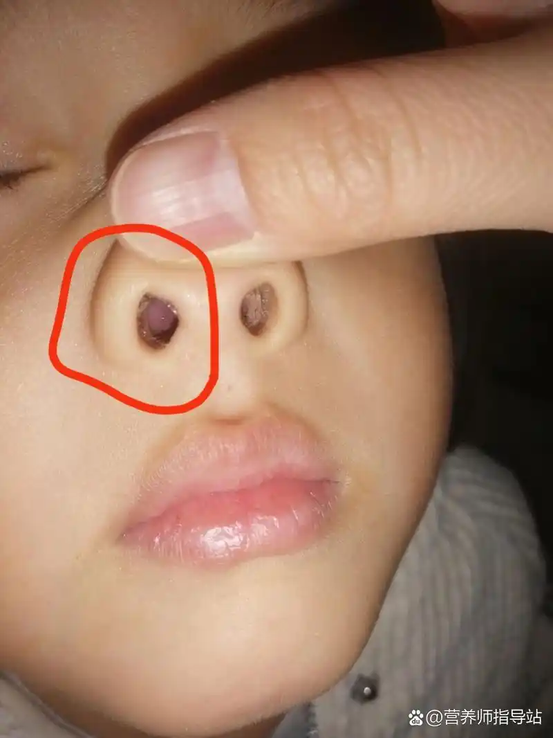 孩子鼻子里红肿了,感觉都堵着了,去药店店员要给我