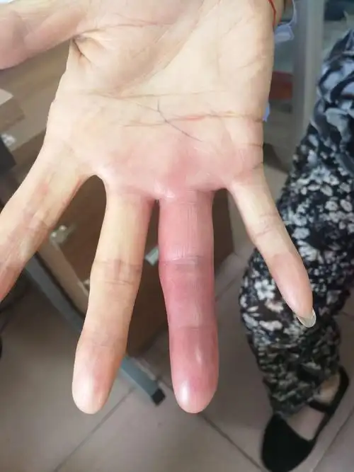 虫咬性皮炎1例治疗分享