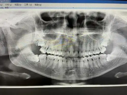 分享一下我的牙片 以及上面的智齿需要拔吗