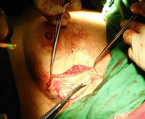 4,直接拉拢缝合切口.