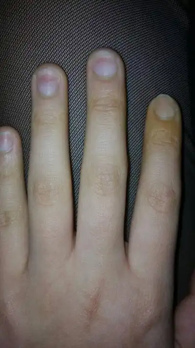 缺钙指甲图片8
