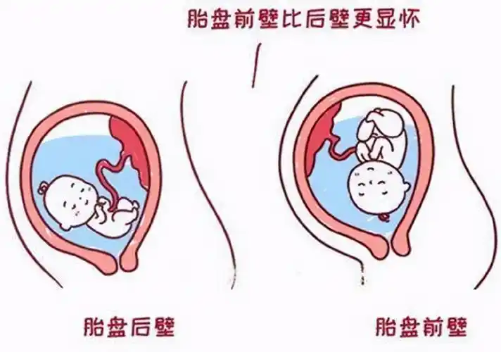 胎盘前壁就是指宝宝的胎盘附着在了子宫靠近肚皮的外面位置,而胎盘后