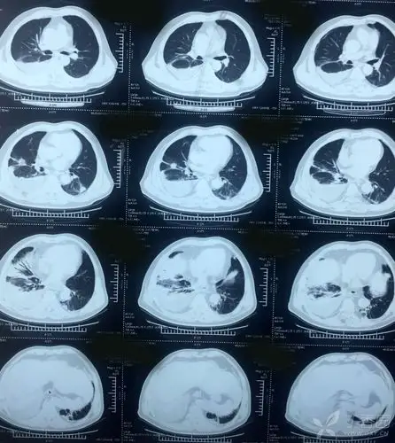 双肺多发结节 穿刺后胸腔积液 [病例帖]