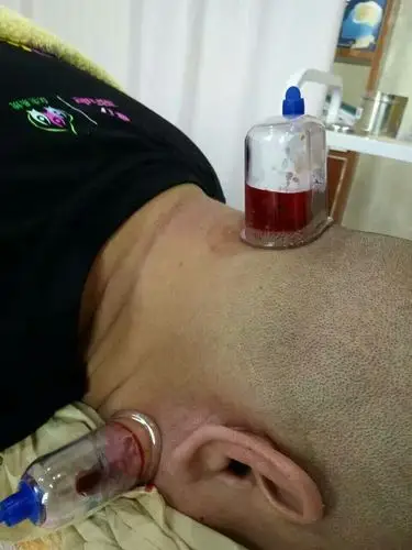 专业泻血排瘀疗法技术培训课正在进行时……,毕业均申报国家权威机构