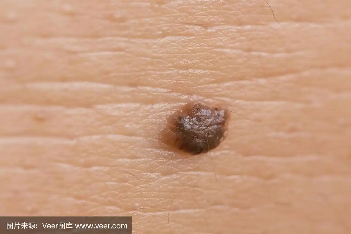 皮肤,痣,褐色,水平画幅,疣