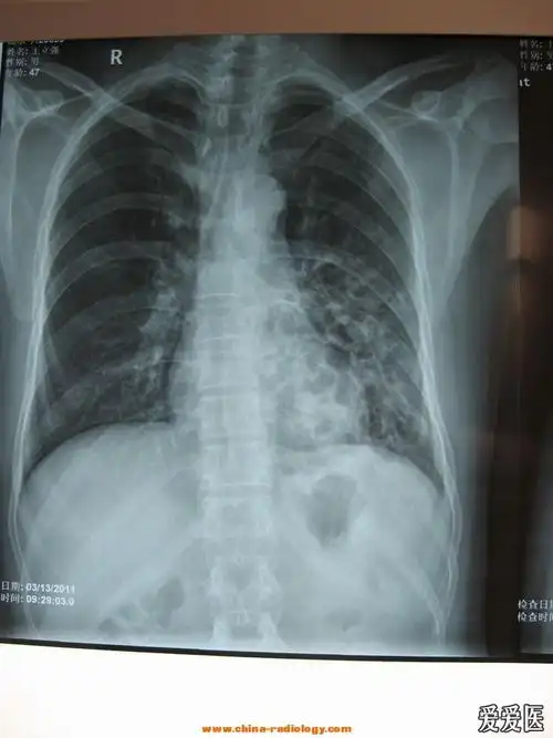 支气管扩张典型图片