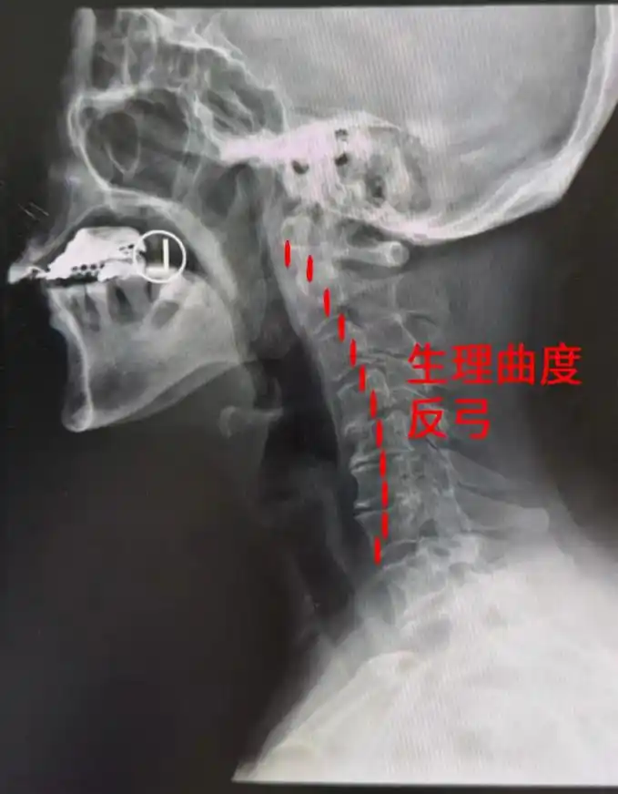 颈椎反弓要手术纠正?看完后,我马上抬起了头!