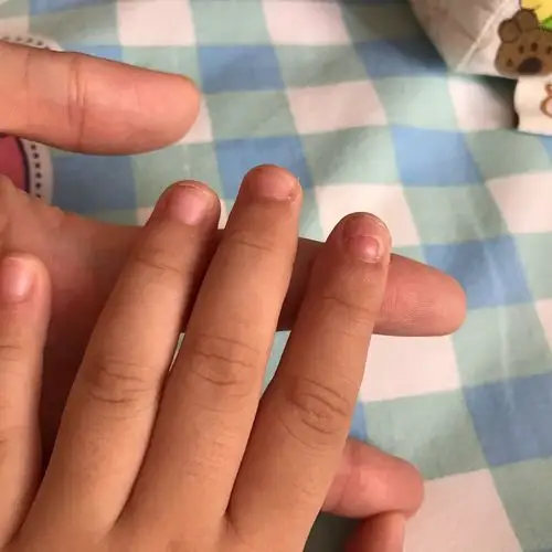 小儿指甲盖大片白絮,分层,能抠到脱落了,是怎么回事?只有拇指,食指有.