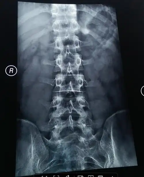 摔了一跤怀疑尾骨骨折或骨裂,去拍了片子遇到个庸医