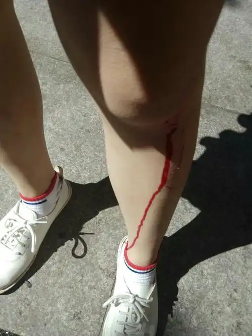 被刮了一道口子,会留疤吗?