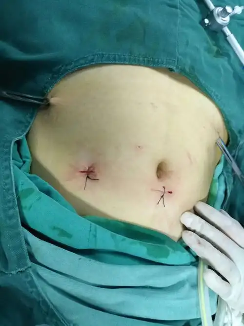 腹腔镜下卵巢囊肿剥除术