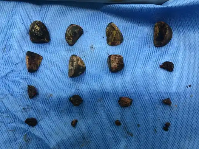 16颗胆结石引发胃穿孔专家胆囊结石久拖不治或引发癌变