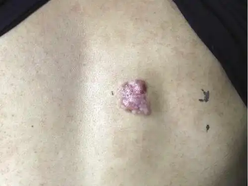 皮肤性病科图谱: 皮肤肿瘤 隆突性皮肤纤维肉瘤