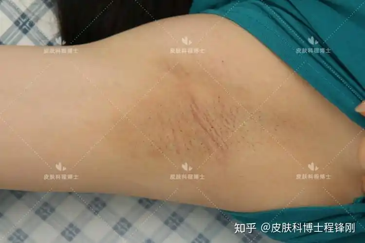 22岁女生,双侧腋下狐臭严重 案例10 - 知乎