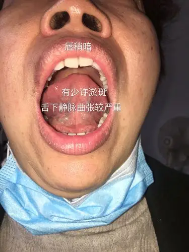 舌下静脉曲张说明淤血较重.淤斑说明淤堵较重.